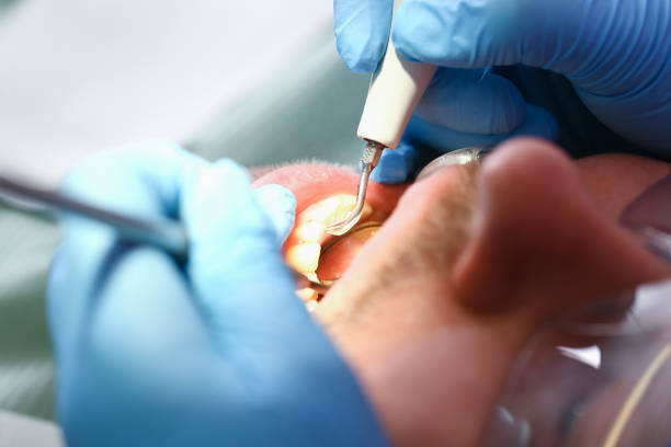 Best Emergency Wisdom Teeth Removal in Fayetteville, AR